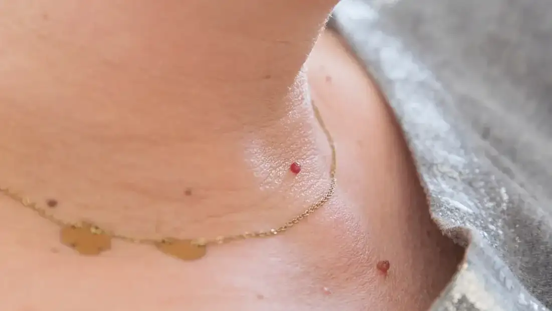 Kırmızı benler zararsız mı, yoksa uyarı işareti mi? Konya'daki uzman cevapladı!