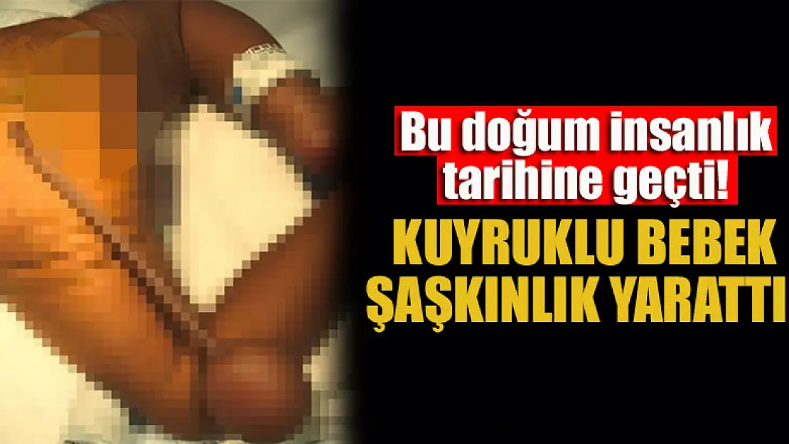 Bu doğum insanlık tarihine geçti! Kuyruklu bebek, doktorlara şaşkınlık yarattı