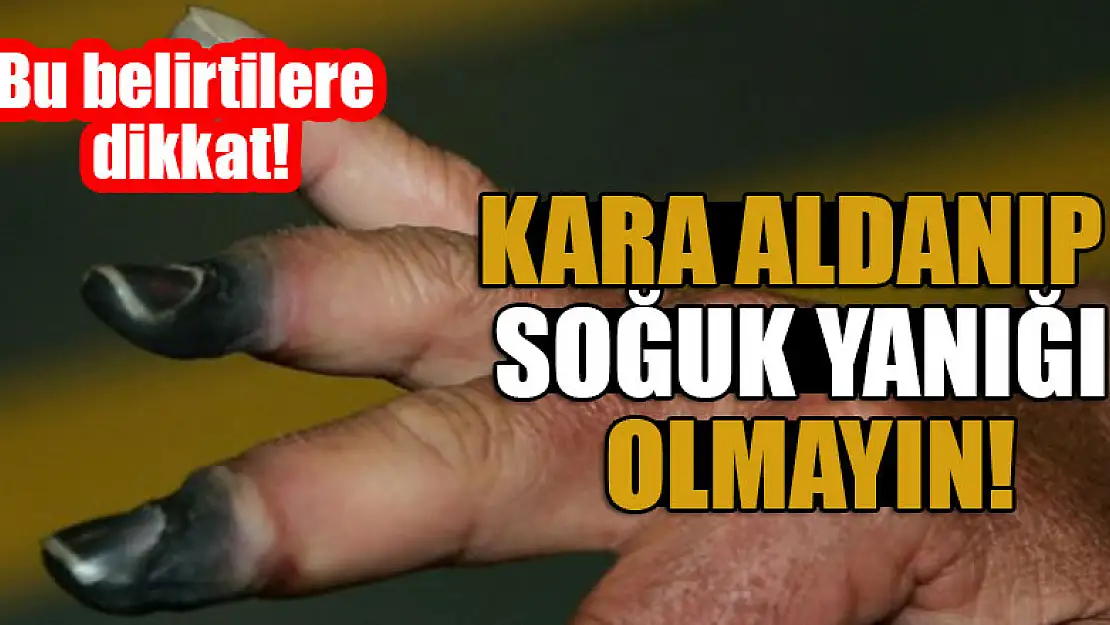 Kara aldanıp soğuk yanığı olmayın Bu belirtilere dikkat!