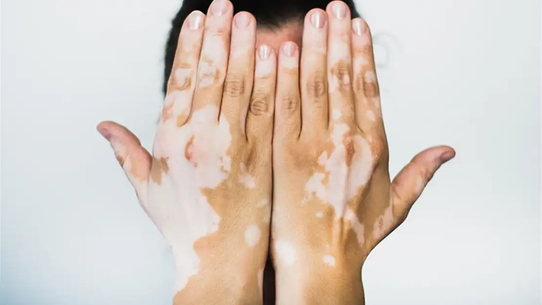 Vitiligo hastalığı nedir?