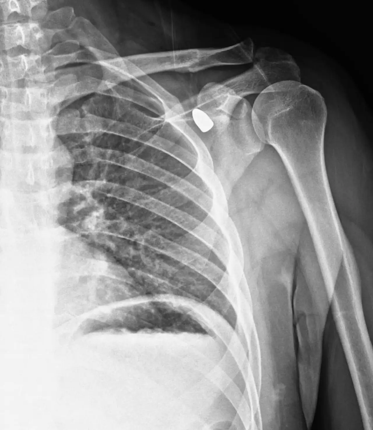 Konya'da şoke eden olay: 6 yıldır omzunda mermi taşıyormuş!