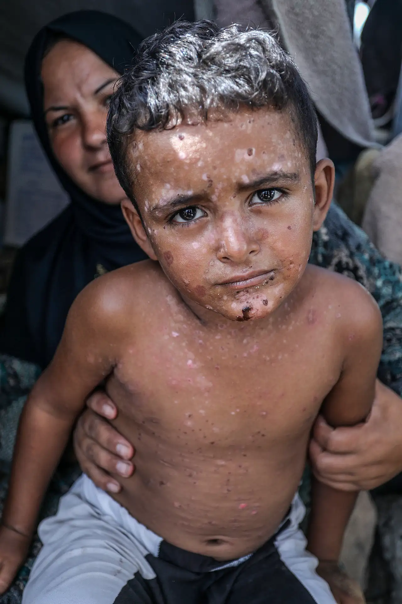 Gazze' de cilt hastalıkları yaygınlaşıyor