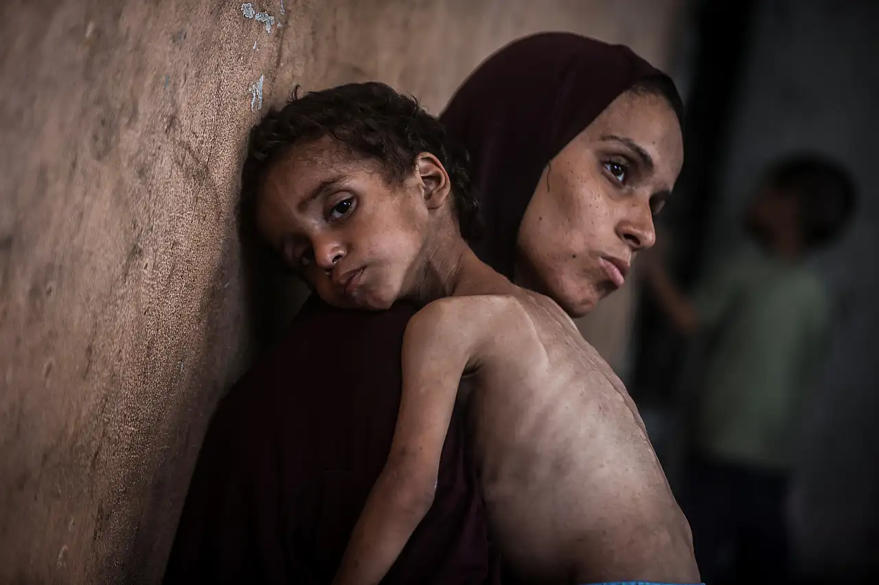 2 yaşındaki çocu açlıkla savaşıyor