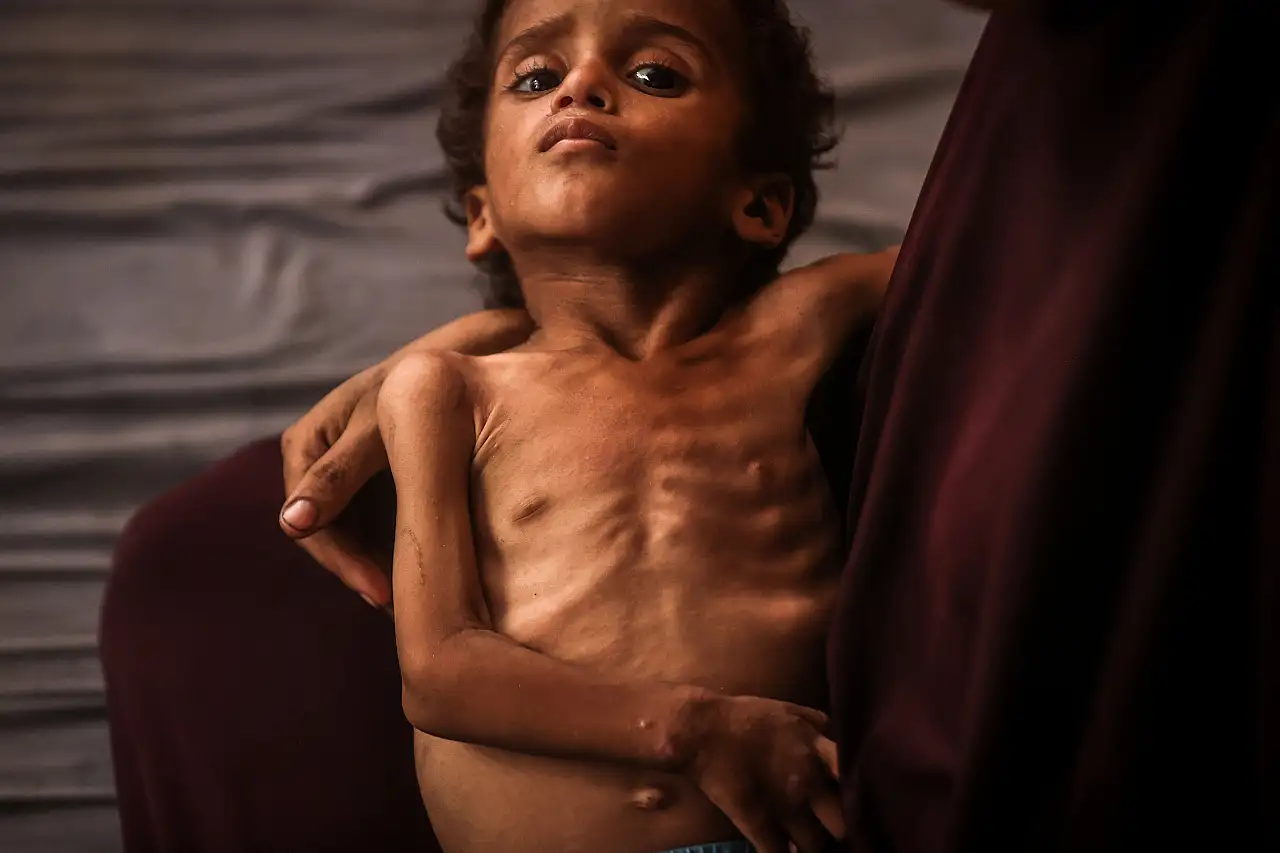 2 yaşındaki çocu açlıkla savaşıyor