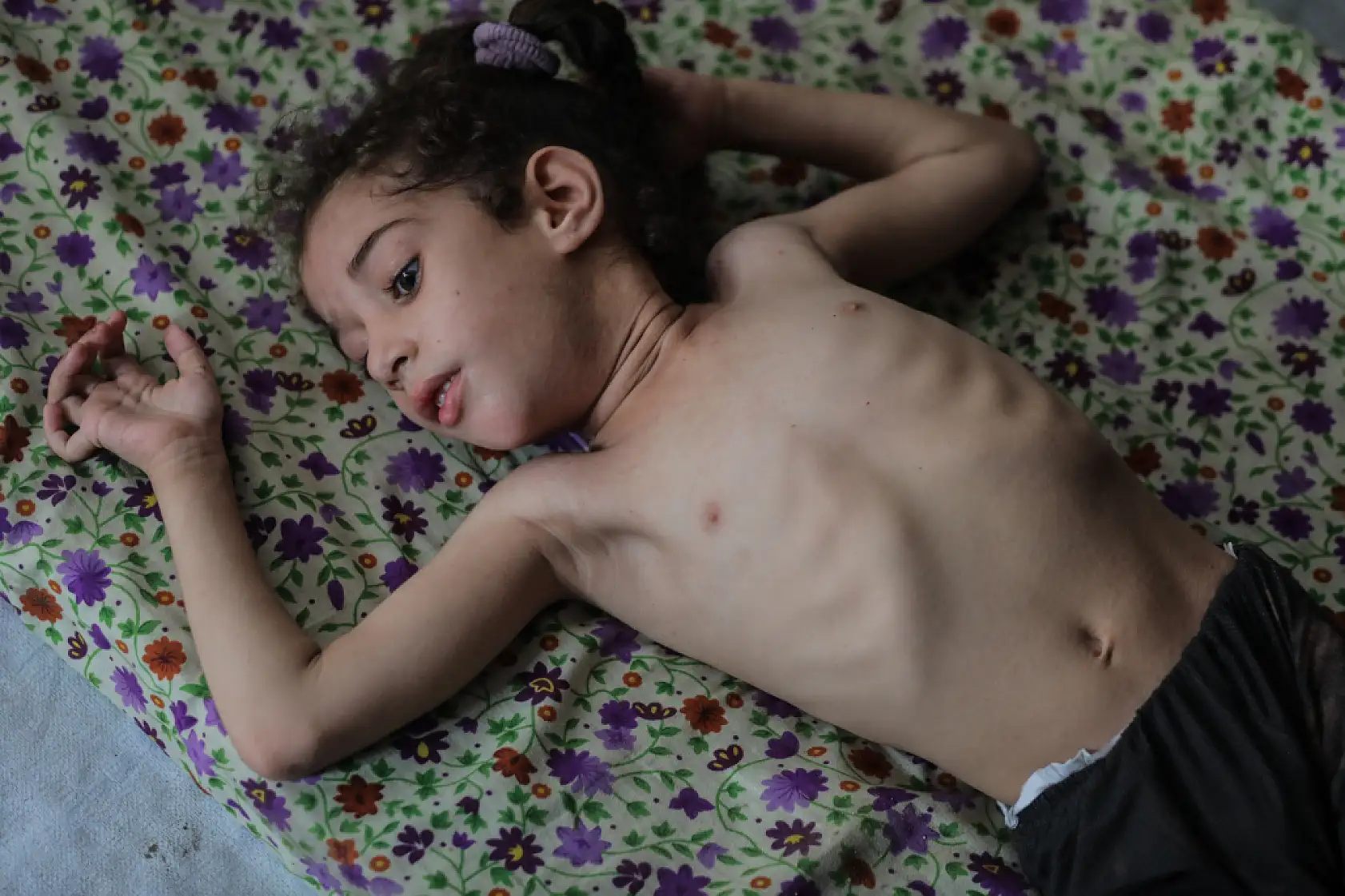 5 yaşındaki Dalya, oksijen eksikliği ve yetersiz beslenme sorunuyla mücadele ediyor