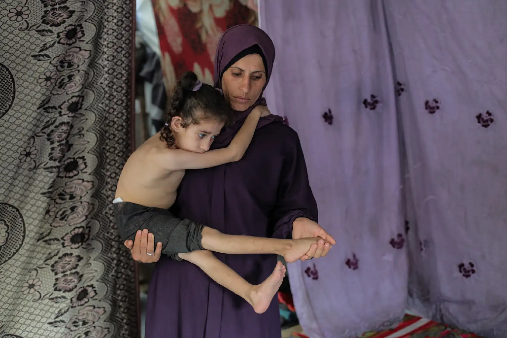 5 yaşındaki Dalya, oksijen eksikliği ve yetersiz beslenme sorunuyla mücadele ediyor