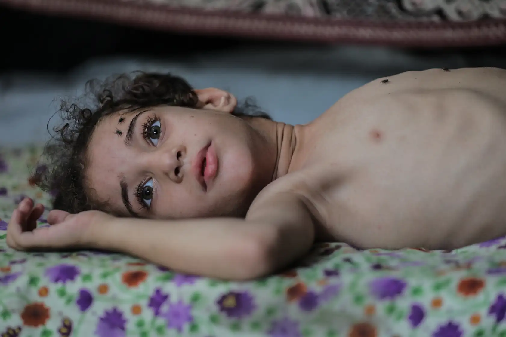 5 yaşındaki Dalya, oksijen eksikliği ve yetersiz beslenme sorunuyla mücadele ediyor