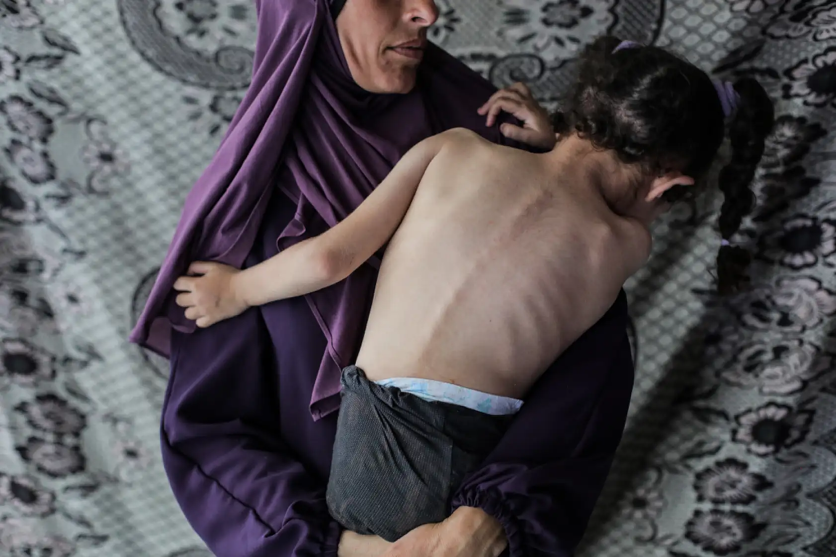 5 yaşındaki Dalya, oksijen eksikliği ve yetersiz beslenme sorunuyla mücadele ediyor