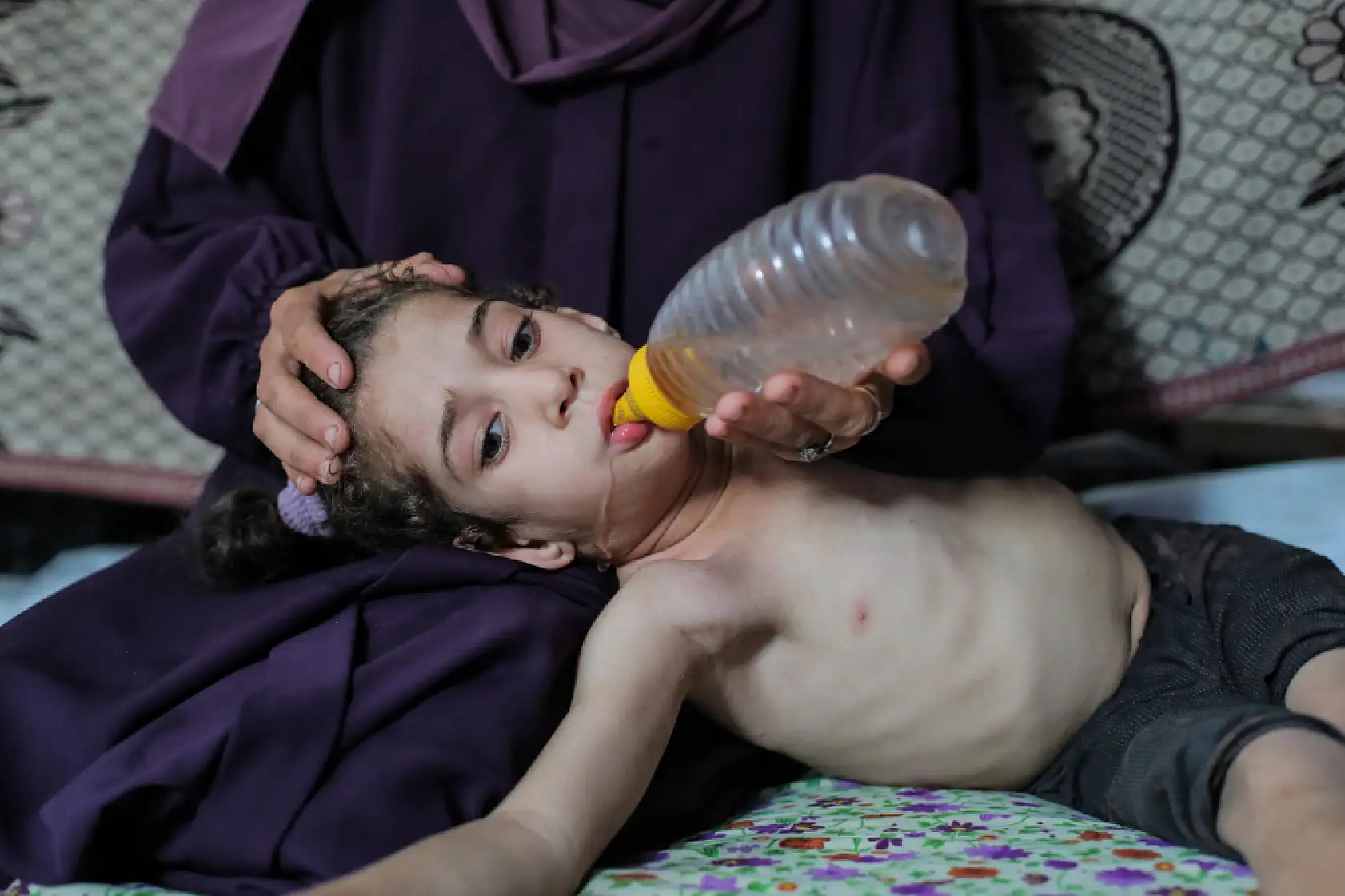 5 yaşındaki Dalya, oksijen eksikliği ve yetersiz beslenme sorunuyla mücadele ediyor