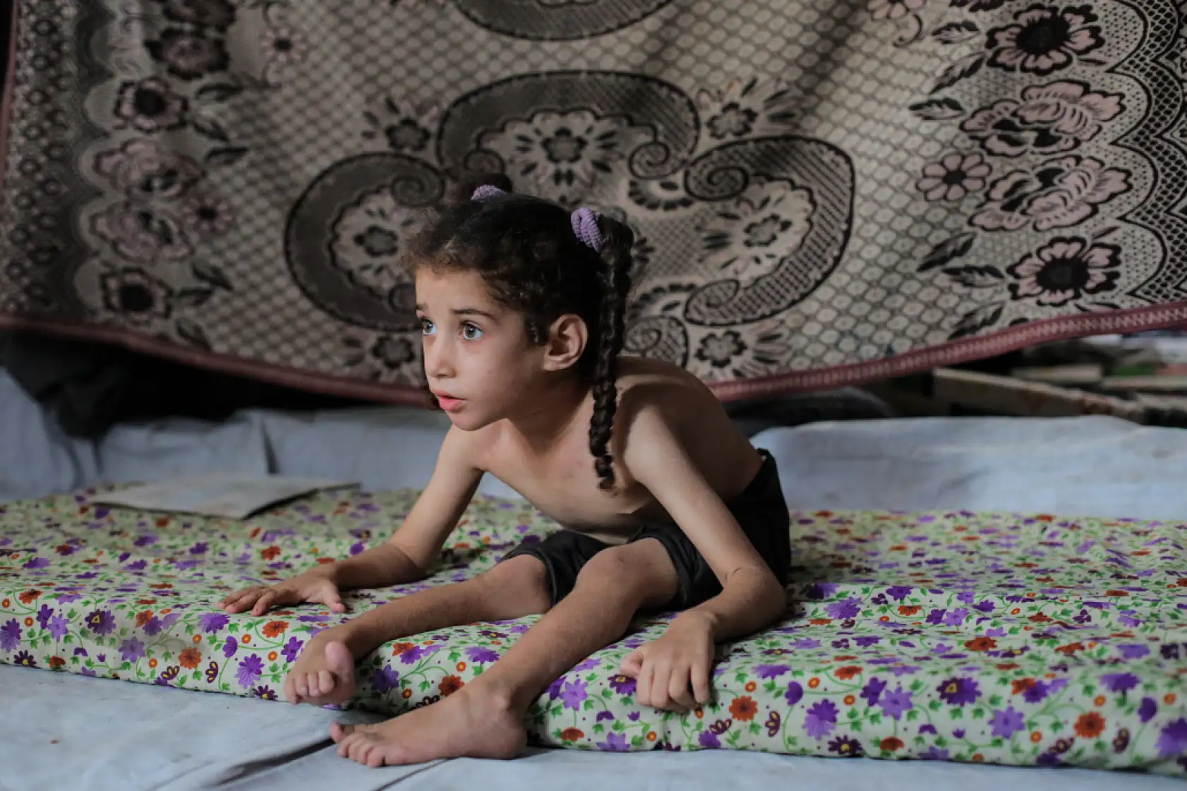 5 yaşındaki Dalya, oksijen eksikliği ve yetersiz beslenme sorunuyla mücadele ediyor