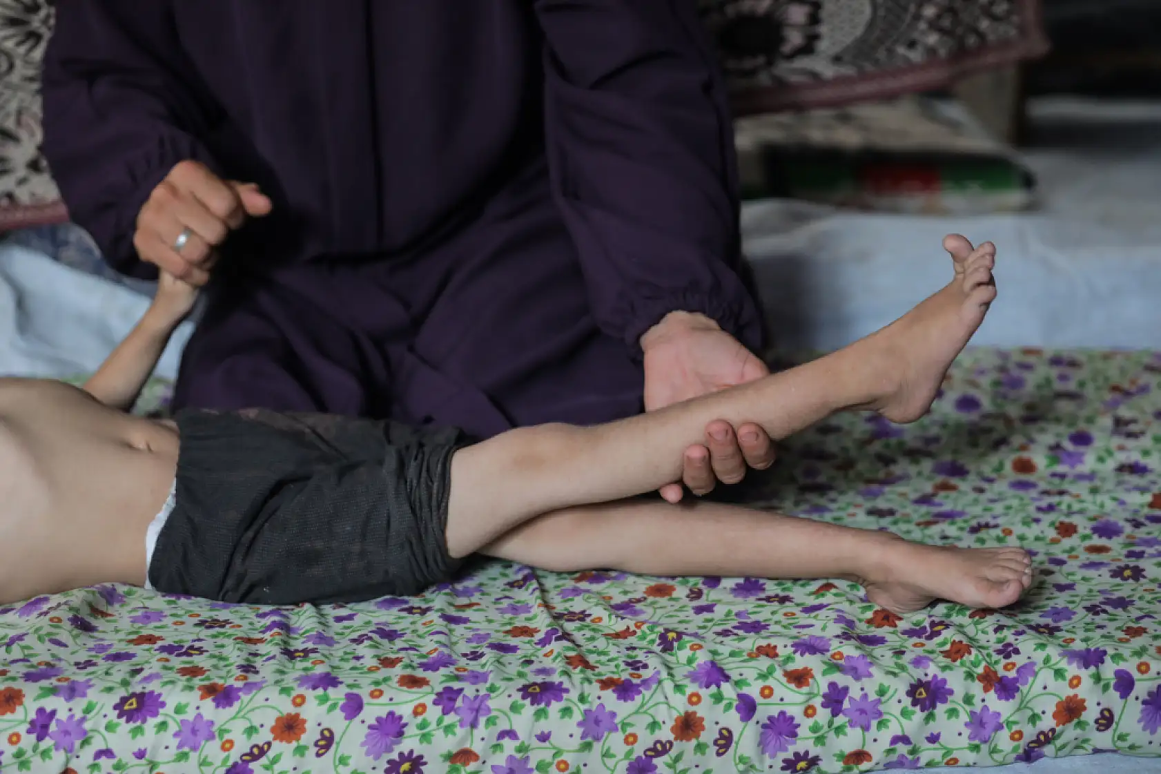 5 yaşındaki Dalya, oksijen eksikliği ve yetersiz beslenme sorunuyla mücadele ediyor