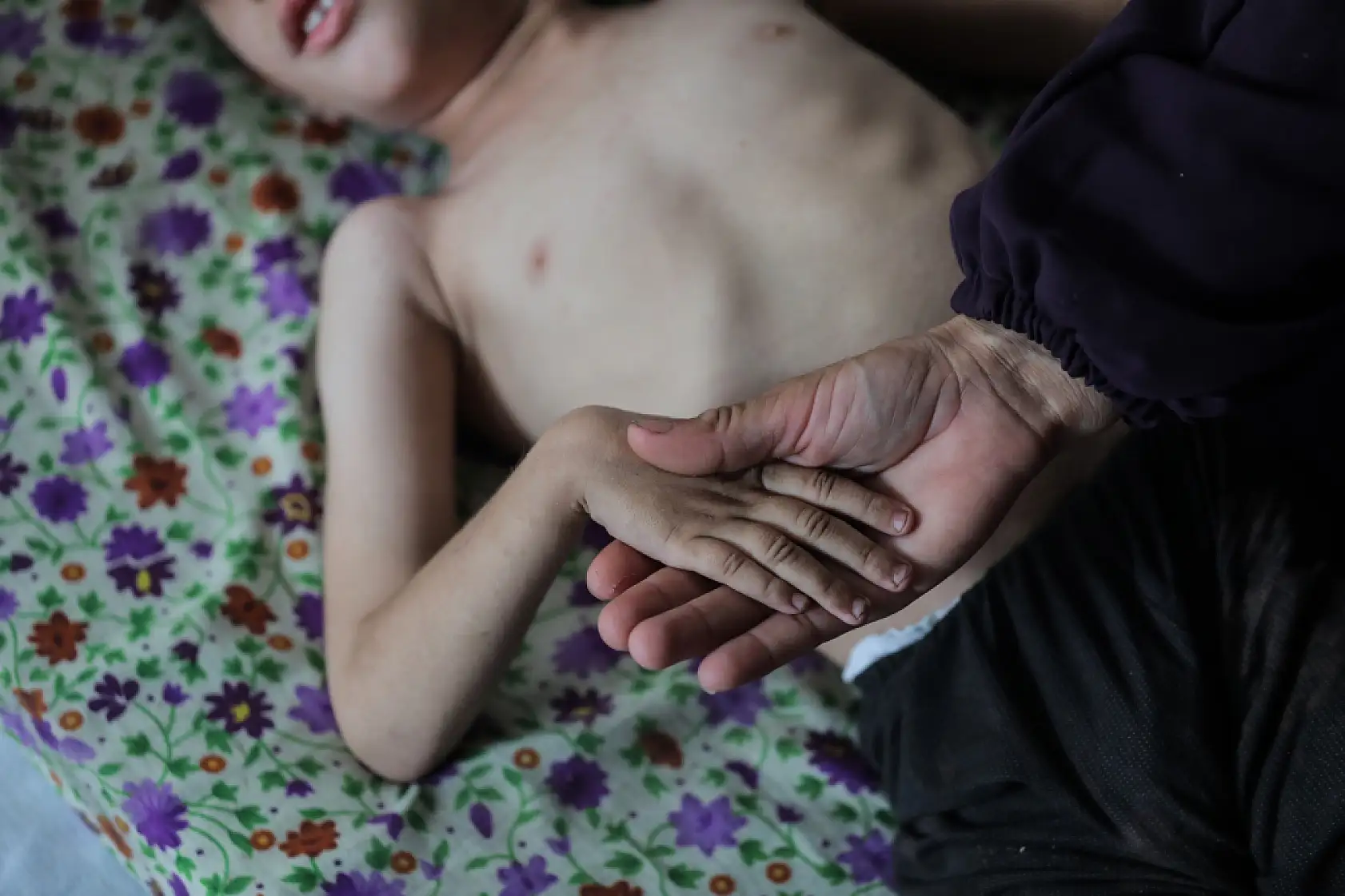 5 yaşındaki Dalya, oksijen eksikliği ve yetersiz beslenme sorunuyla mücadele ediyor