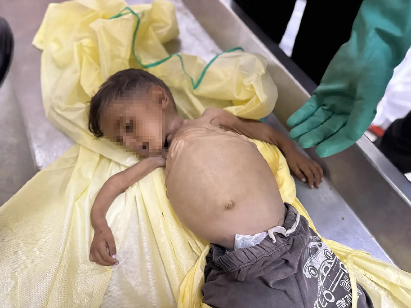 5 yaşındaki çocuk yetersiz beslenme nedeniyle hayatını kaybetti