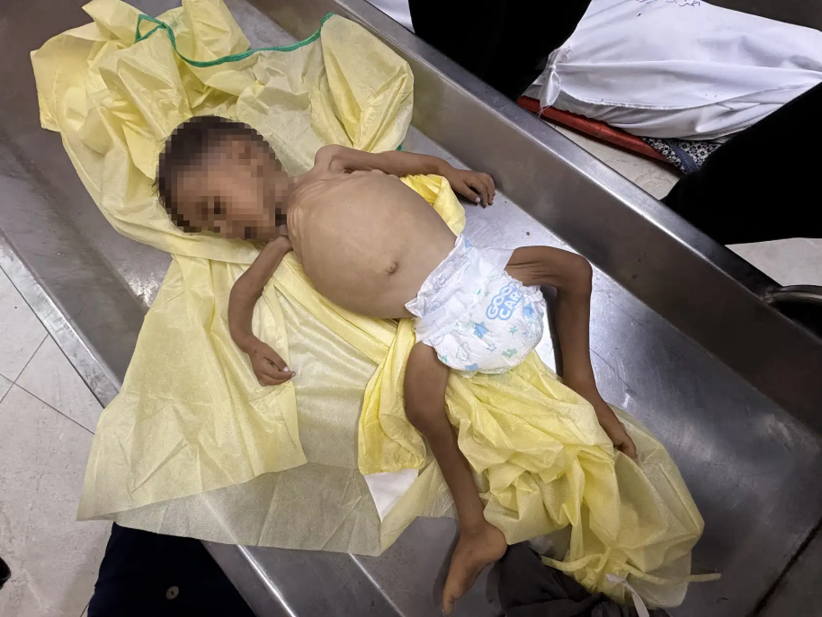 5 yaşındaki çocuk yetersiz beslenme nedeniyle hayatını kaybetti