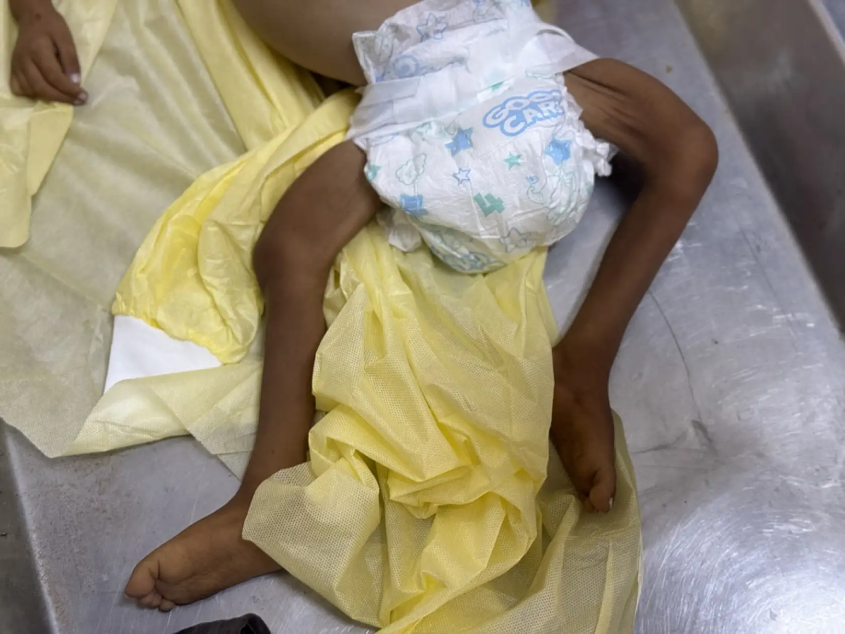 5 yaşındaki çocuk yetersiz beslenme nedeniyle hayatını kaybetti