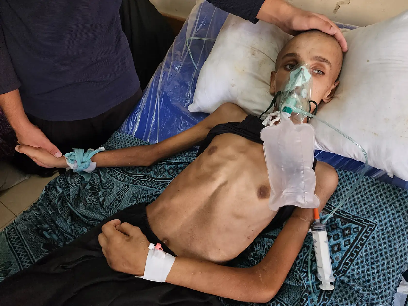 Yaralı çocuk yaşam mücadelesi veriyor: Yetersiz beslenme sonucu 20 kilo kaybetti