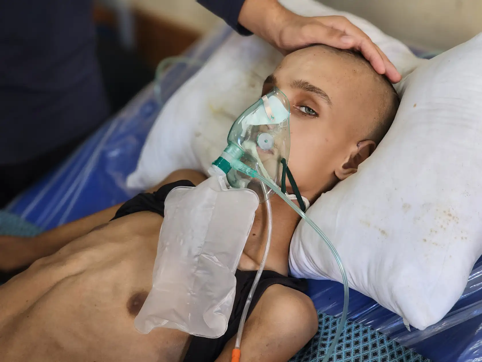 Yaralı çocuk yaşam mücadelesi veriyor: Yetersiz beslenme sonucu 20 kilo kaybetti