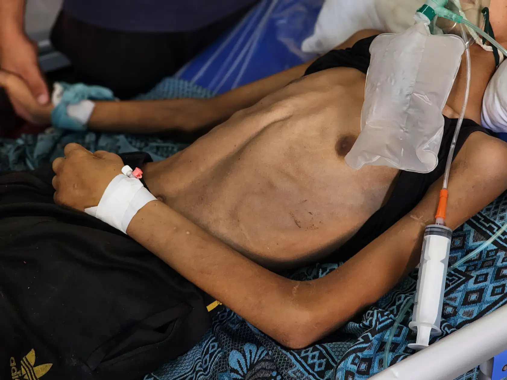 Yaralı çocuk yaşam mücadelesi veriyor: Yetersiz beslenme sonucu 20 kilo kaybetti