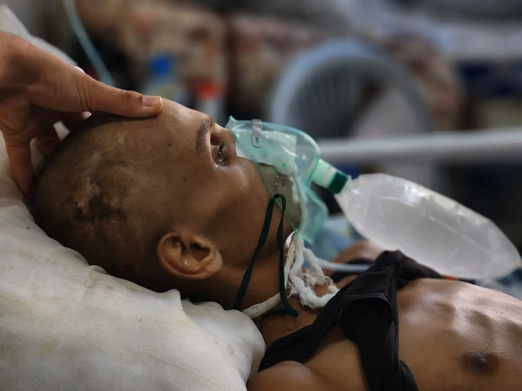 Yaralı çocuk yaşam mücadelesi veriyor: Yetersiz beslenme sonucu 20 kilo kaybetti