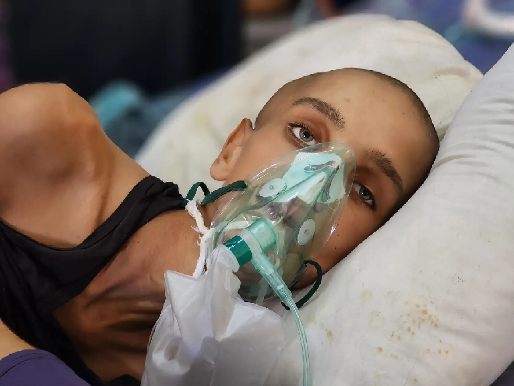 Yaralı çocuk yaşam mücadelesi veriyor: Yetersiz beslenme sonucu 20 kilo kaybetti