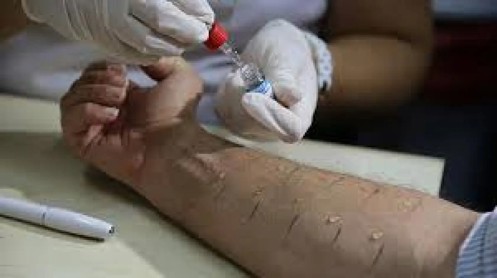 Modern diyetin gizli tehlikesi: Beslenme alışkanlıklarının değişmesi alerjiyi tetikliyor