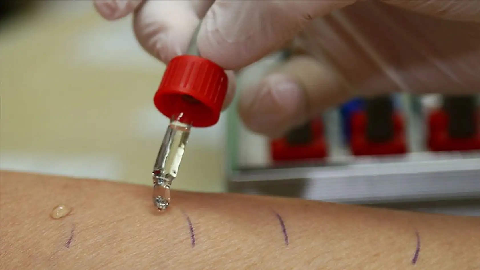 Modern diyetin gizli tehlikesi: Beslenme alışkanlıklarının değişmesi alerjiyi tetikliyor