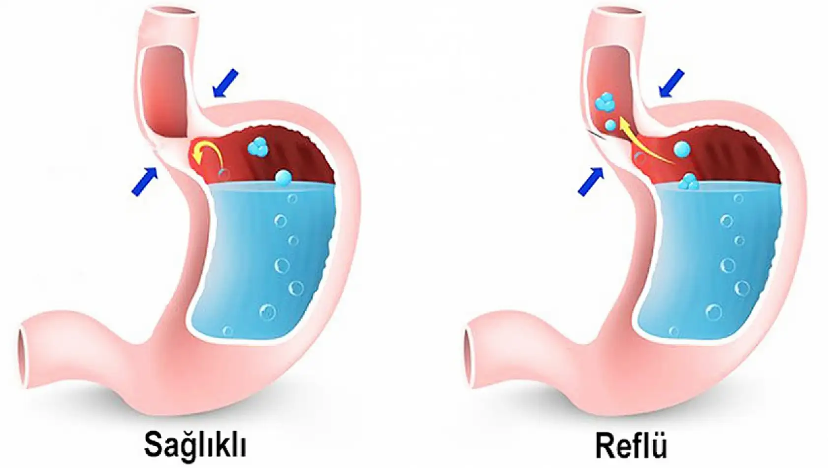 Gastroözofageal Reflü Hastalığı: Gastroözofageal Reflü Hastalığı Nedir? Gastroözofageal Reflü Hastalığı Belirtileri!