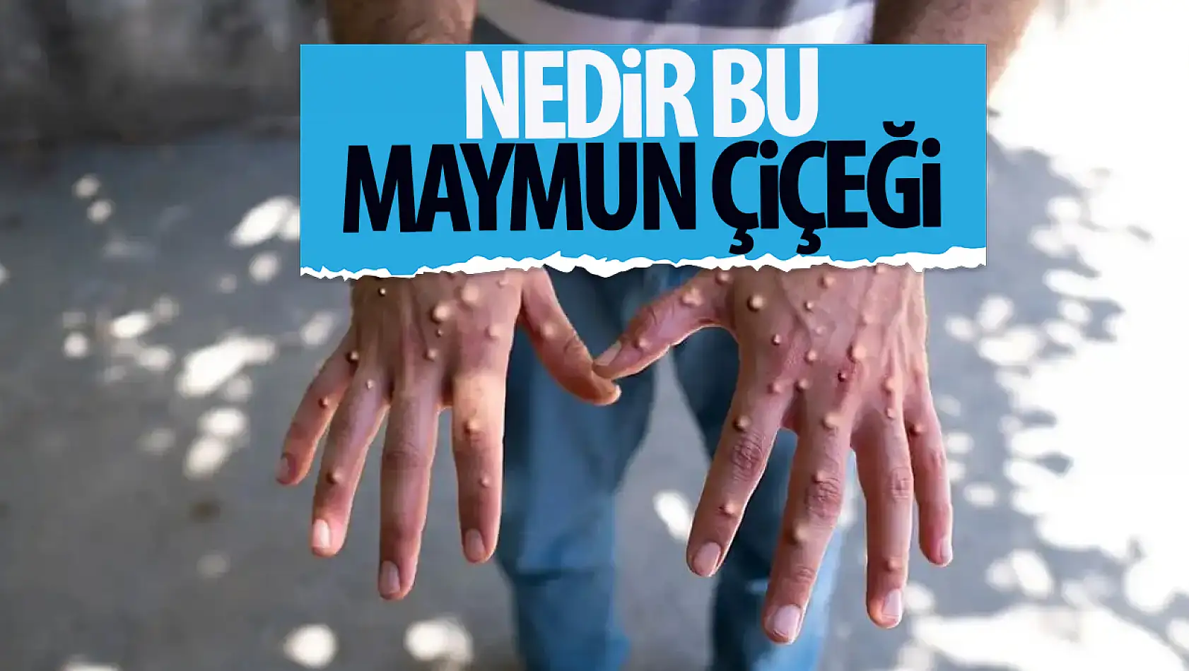 Maymun çiçeği virüsü nedir? Maymun çiçeği virüsünden nasıl korunur?  