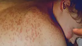 Kızamık yeniden alarm veriyor! Çocuklarda beyin hasarı riski