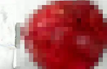 Konya'da tıp başarısı: Rahimden 40 santimetrelik dev kitle çıkarıldı