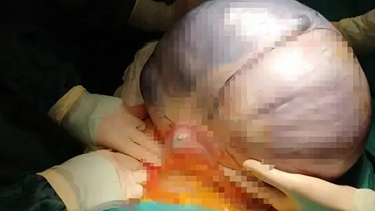 Konya'da yaşayan 89 yaşındaki hastadan 35 santimetrelik kitle çıktı