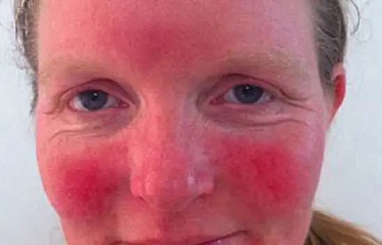 Beyaz tenli kadınlar dikkat! Bu yiyeceklerden mutlaka uzak durun