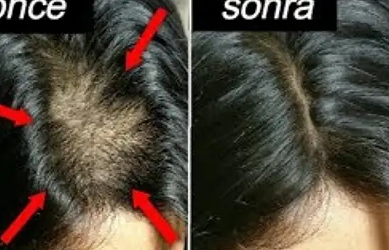 Çim adam gibi saç fışkırtacak 3 doğal malzeme! Saça sürmek yetiyor.