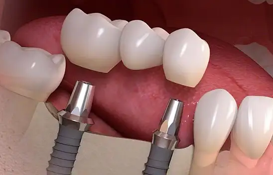 Diş İmplantı sonrası yapılması gerekenler