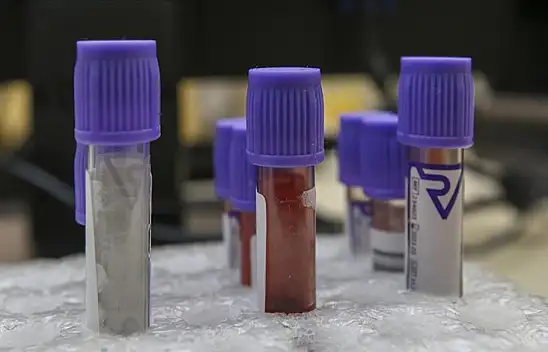 İngiltere'de denenen kan testiyle her üç kanserden ikisi tespit edildi