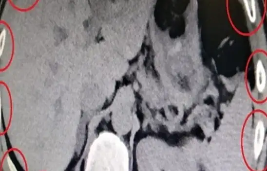 Midesinde ve bağırsağında uyuşturucu taşıyan şahıs tutuklandı