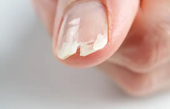 Tırnak kırılması neyin belirtisi? Bu 3 hastalığın belirtisi olabilir...