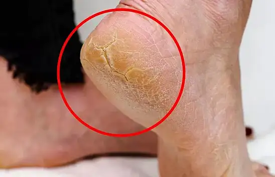 Topuk çatlaklarına ne iyi gelir? Bu bitkisel yöntemler topuk çatlaklarının kökünü kurutuyor ve pamuk gibi yapıyor