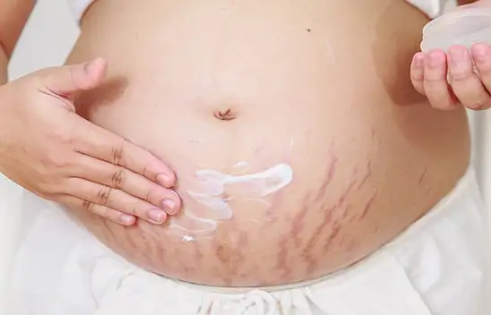 Uzmanı Açıkladı: Hamilelik Çatlakları İşte Bu Yüzden Oluyor…