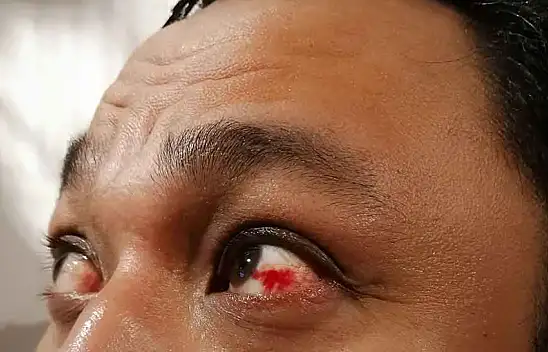 Uzmanlar uyardı: Körlüğe neden oluyor