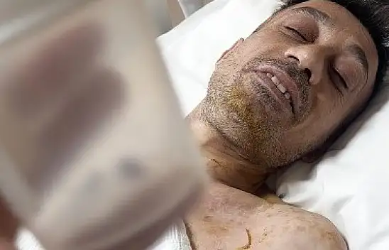 Vücudunda mermiyle geçen 18 yıl: Kurşun çıkarıldı, ilk kez uyudu