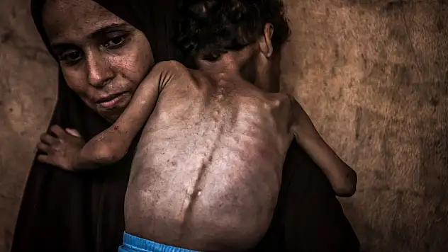 2 yaşındaki çocu açlıkla savaşıyor