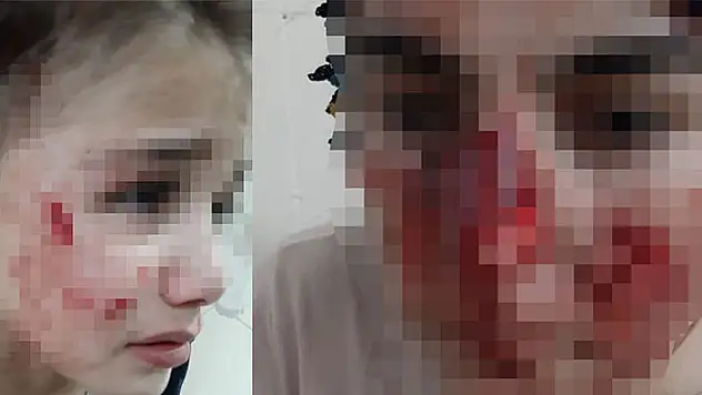 Yine sokak köpeği vahşeti: Vatandaşların yüzleri parçalandı