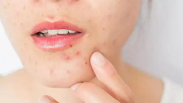 Akne İzlerine Dikkat!