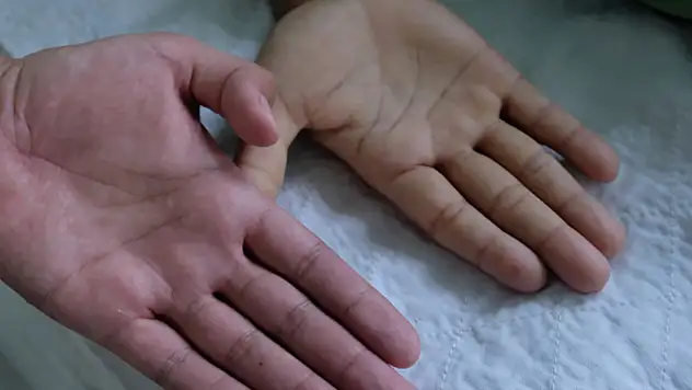 Anemi: Sessiz Sağlık Tehdidi