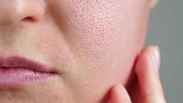 Diyetisyenlerden uyarı: Yağlı cilde sahipseniz bunları sakın tüketmeyin!