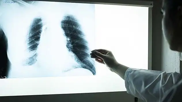 Dünyada 2021'de 1,6 milyon kişi verem nedeniyle yaşamını kaybetti