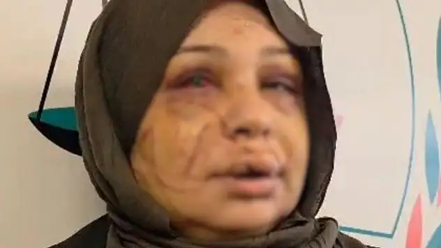 Eşinin yüzünü kestiği iddia edilen polis davasında kritik karar