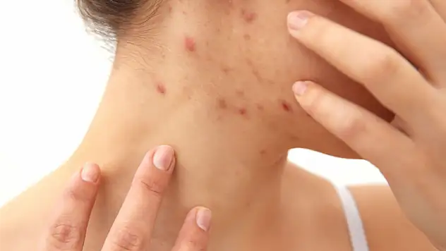 Faydalarına inanamayacaksınız! Gül suyunun bilinmeyenleri...