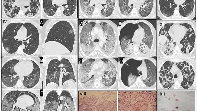 Gençlerde artan ani ölümlerin nedeni, pandemiye dayanıyor